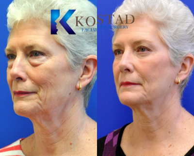 Eyelid Surgery before and after photo