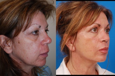 Facelift before and after photo