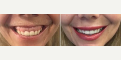 Botox for Gummy Smile before and after photo