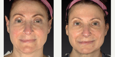 Botox before and after photo