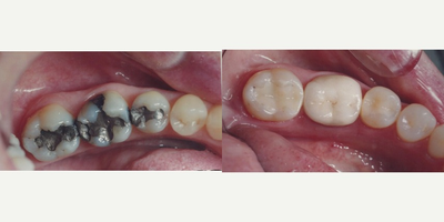 Dental Bonding before and after photo