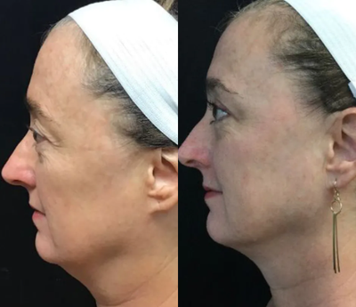 Eyelid Surgery before and after photo