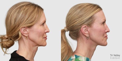 Facial Fat Transfer before and after photo