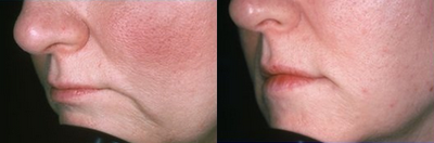 Lip Fillers before and after photo