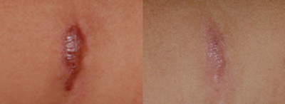 Pixel Laser before and after photo