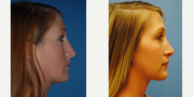Rhinoplasty before and after photo