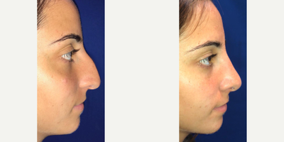 Rhinoplasty before and after photo