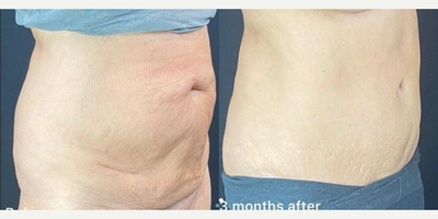 Tummy Tuck before and after photo