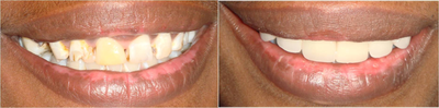 Dental Crown before and after photo