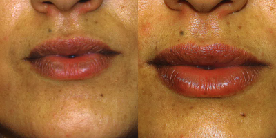 Juvederm before and after photo