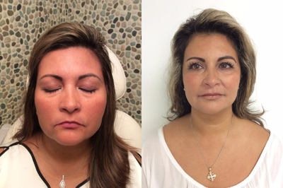 Kybella before and after photo