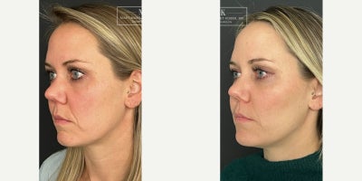 Dermal Fillers before and after photo
