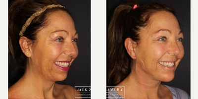 Renuvion before and after photo