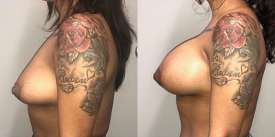 Breast Augmentation before and after photo