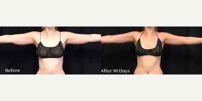 CoolSculpting before and after photo