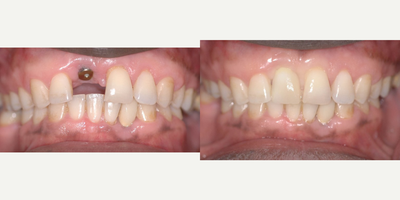 Dental Implants before and after photo