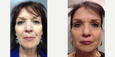 Voluma before and after photo