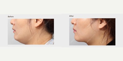 Chin Liposuction before and after photo