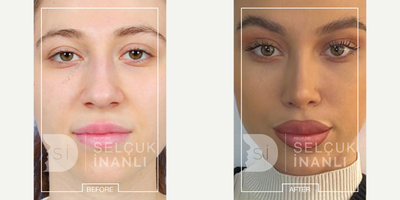 Lip Fillers before and after photo