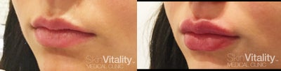 Lip Fillers before and after photo