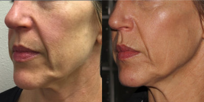 Nonsurgical Facelift before and after photo