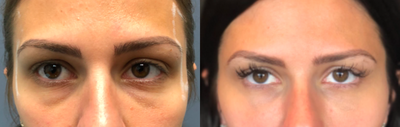 Restylane before and after photo