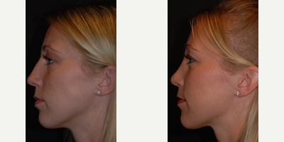 Rhinoplasty before and after photo