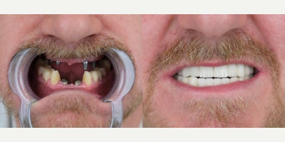 All-on-4 Dental Implants before and after photo