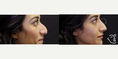 Juvederm before and after photo