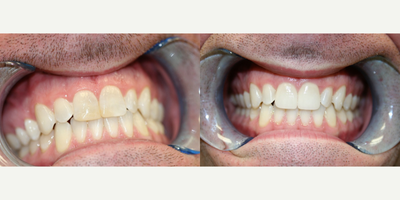 Porcelain Veneers before and after photo