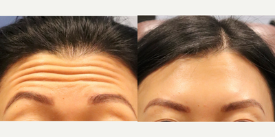 Botox before and after photo