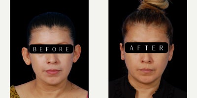 Ear Surgery before and after photo