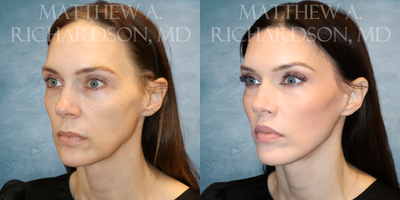 Forehead Reduction before and after photo