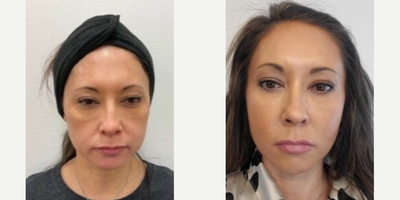 Lip Fillers before and after photo