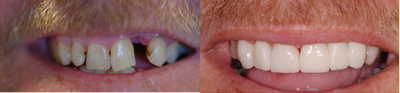 Smile Makeover before and after photo