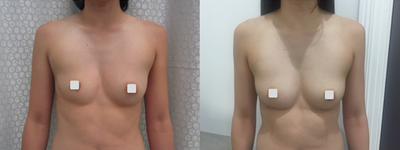 Breast Implants before and after photo