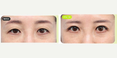 Brow Lift before and after photo