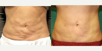 Exilis before and after photo