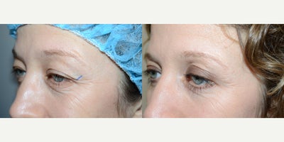 Eyelid Surgery before and after photo