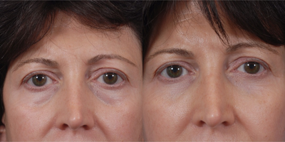 Juvederm before and after photo