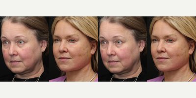 Deep Plane Facelift before and after photo
