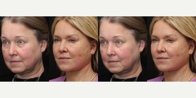 Deep Plane Facelift before and after photo