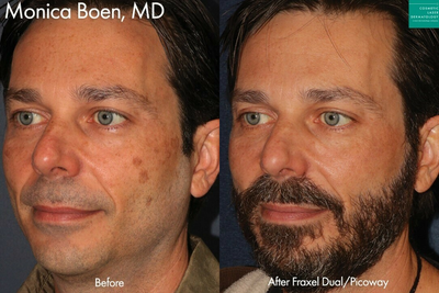 Fraxel Laser before and after photo