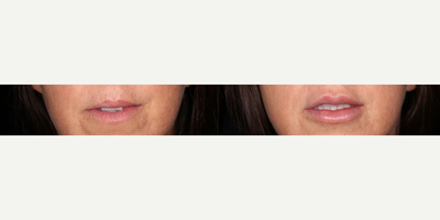 Juvederm before and after photo