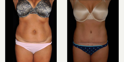 Tummy Tuck before and after photo