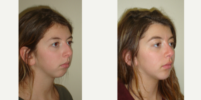 Chin Implant before and after photo