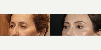 Eyelid Surgery before and after photo