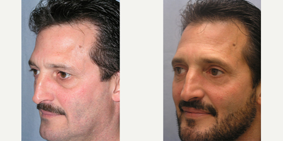 Facelift before and after photo