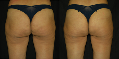 Cellfina before and after photo