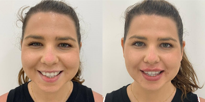 Dermal Fillers before and after photo